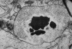F,15y. | infantile neuroaxonal dystrophy (Seitelberger) F,15y. | infantile neuroaxonal dystrophy (Seitelberger)
